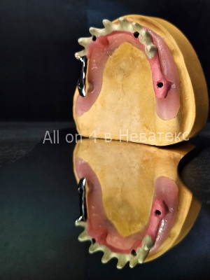 фото этапов операции all on 4 на верхней челюсти балка-гребенка на модели